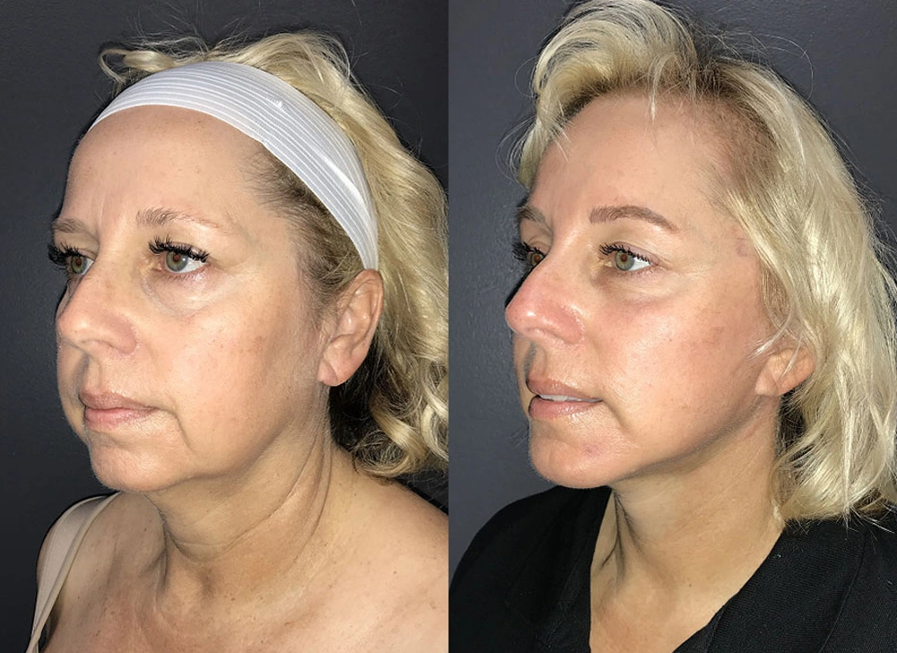 Real Patient Results in Newport Beach, CA. Preformed by Semira Bayait, MD, FACS.
