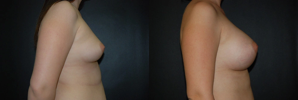 Real Patient Results in Newport Beach, CA. Preformed by Semira Bayait, MD, FACS.