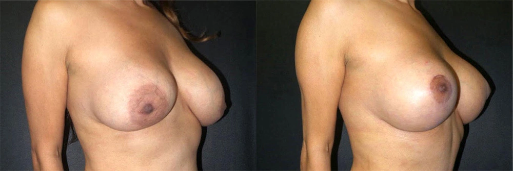 Real Patient Results in Newport Beach, CA. Preformed by Semira Bayait, MD, FACS.