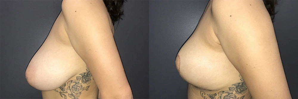 Real Patient Results in Newport Beach, CA. Preformed by Semira Bayait, MD, FACS.