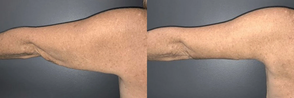 Real Patient Results in Newport Beach, CA. Preformed by Semira Bayait, MD, FACS.