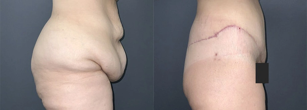 Real Patient Results in Newport Beach, CA. Preformed by Semira Bayait, MD, FACS.