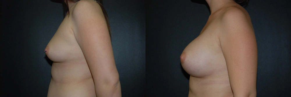 Real Patient Results in Newport Beach, CA. Preformed by Semira Bayait, MD, FACS.
