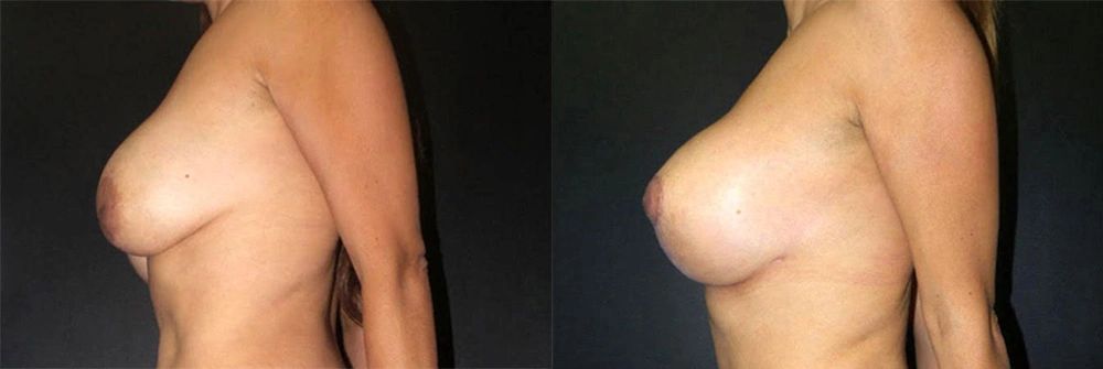 Real Patient Results in Newport Beach, CA. Preformed by Semira Bayait, MD, FACS.