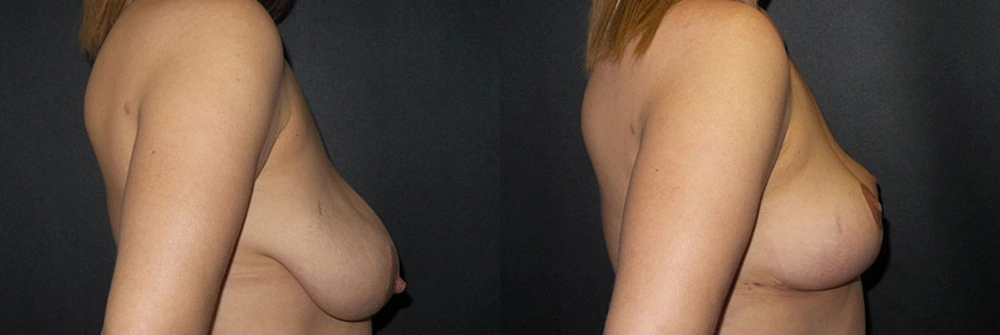 Real Patient Results in Newport Beach, CA. Preformed by Semira Bayait, MD, FACS.