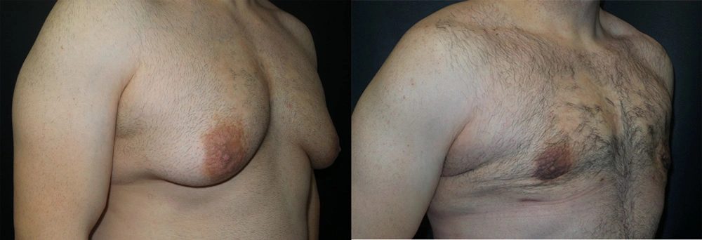 Real Patient Results in Newport Beach, CA. Preformed by Semira Bayait, MD, FACS.