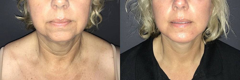 Real Patient Results in Newport Beach, CA. Preformed by Semira Bayait, MD, FACS.