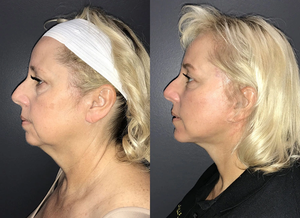 Real Patient Results in Newport Beach, CA. Preformed by Semira Bayait, MD, FACS.