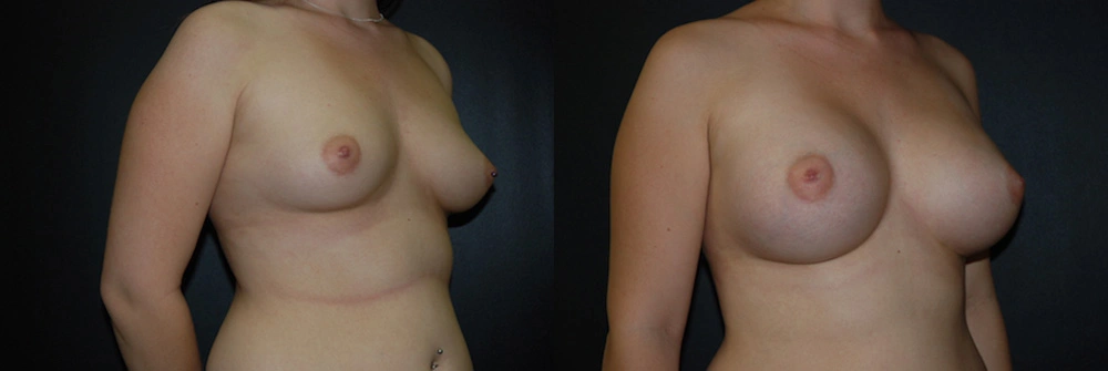 Real Patient Results in Newport Beach, CA. Preformed by Semira Bayait, MD, FACS.