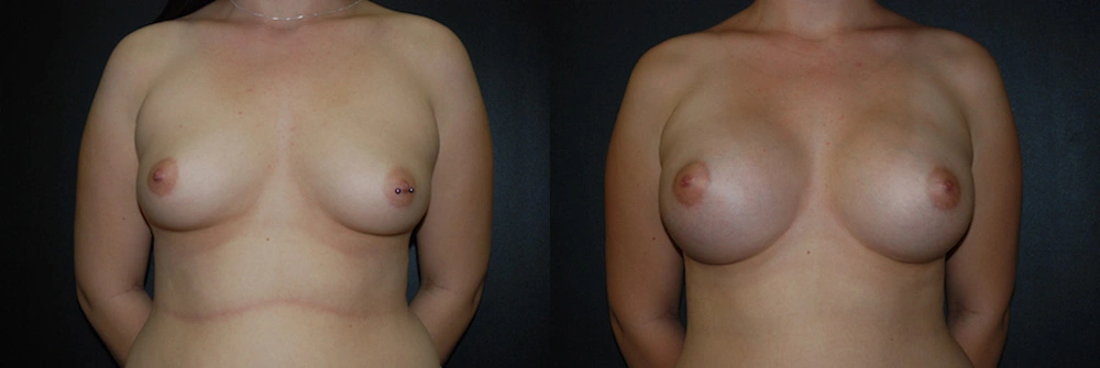 Real Patient Results in Newport Beach, CA. Preformed by Semira Bayait, MD, FACS.