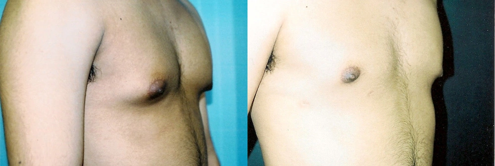 Real Patient Results in Newport Beach, CA. Preformed by Semira Bayait, MD, FACS.