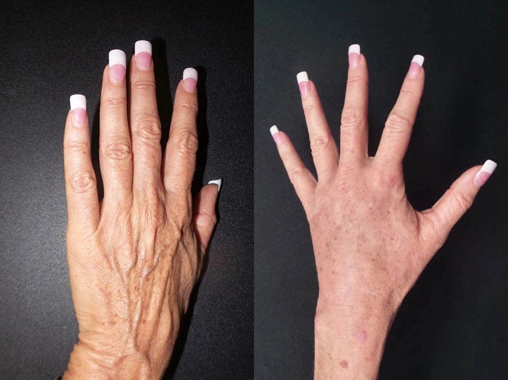 Real Patient Results in Newport Beach, CA. Preformed by Semira Bayait, MD, FACS.