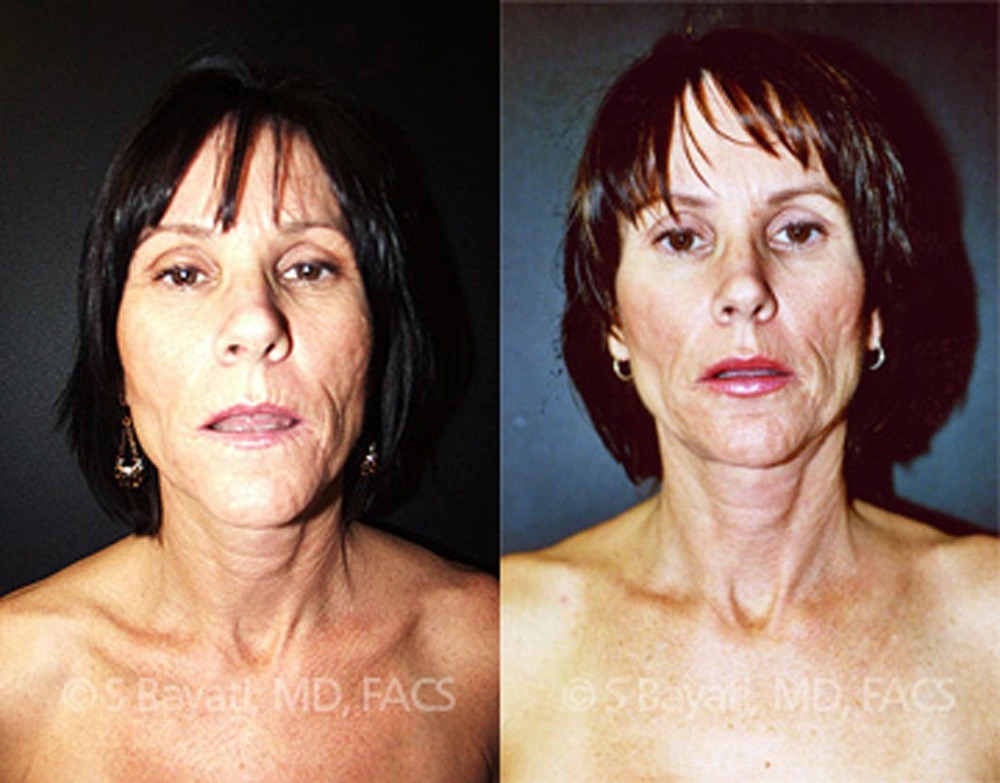 Real Patient Results in Newport Beach, CA. Preformed by Semira Bayait, MD, FACS.
