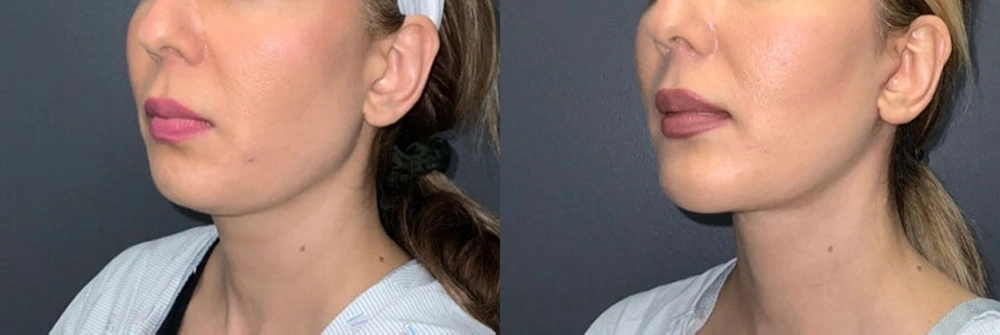 Real Patient Results in Newport Beach, CA. Preformed by Semira Bayait, MD, FACS.