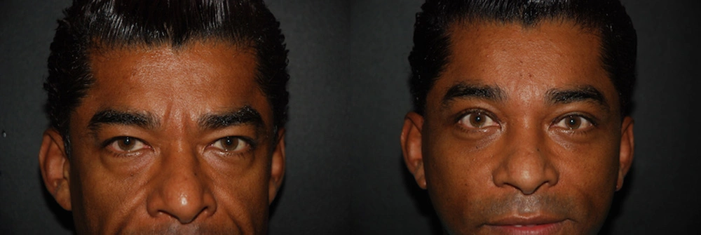 Real Patient Results in Newport Beach, CA. Preformed by Semira Bayait, MD, FACS.