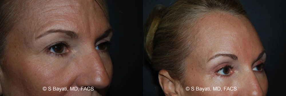 Real Patient Results in Newport Beach, CA. Preformed by Semira Bayait, MD, FACS.
