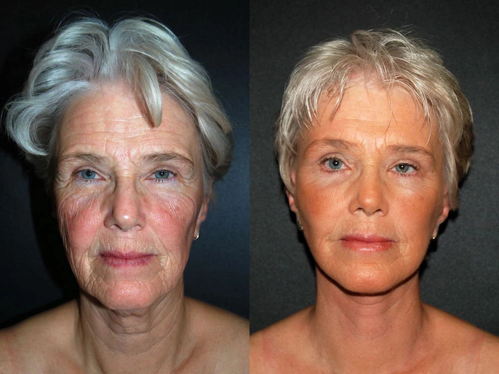 Real Patient Results in Newport Beach, CA. Preformed by Semira Bayait, MD, FACS.