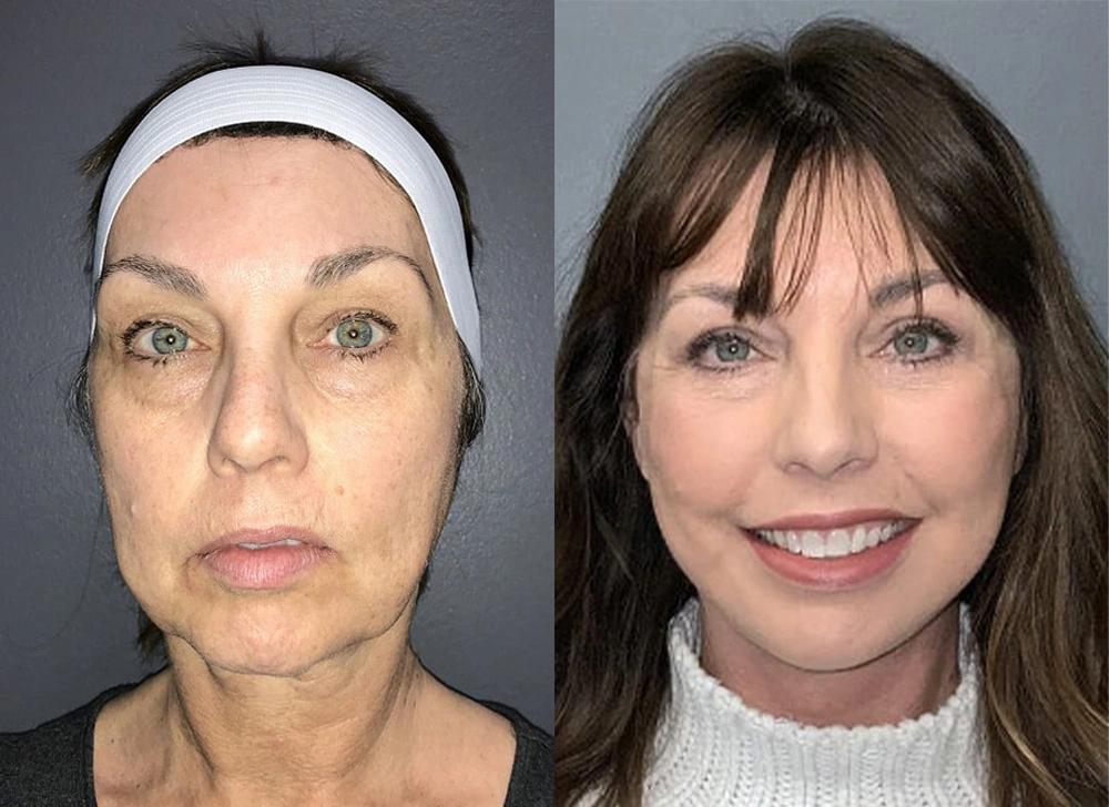 Real Patient Results in Newport Beach, CA. Preformed by Semira Bayait, MD, FACS.