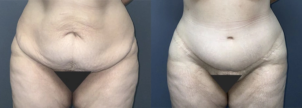Real Patient Results in Newport Beach, CA. Preformed by Semira Bayait, MD, FACS.