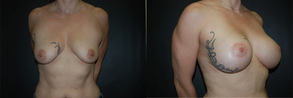 Real Patient Results in Newport Beach, CA. Preformed by Semira Bayait, MD, FACS.