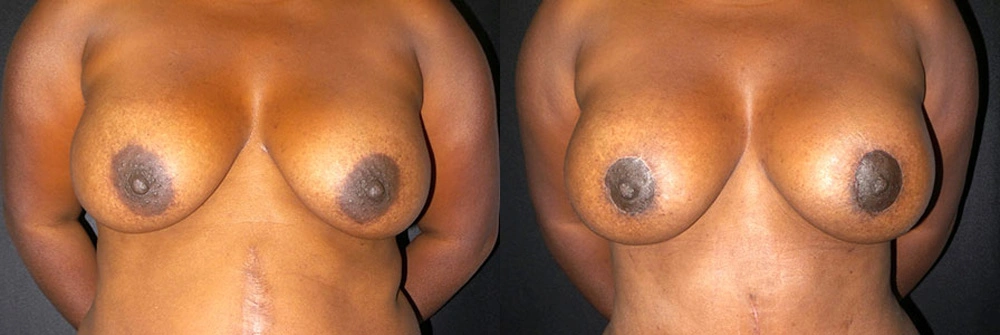 Real Patient Results in Newport Beach, CA. Preformed by Semira Bayait, MD, FACS.