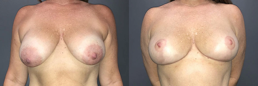 Real Patient Results in Newport Beach, CA. Preformed by Semira Bayait, MD, FACS.