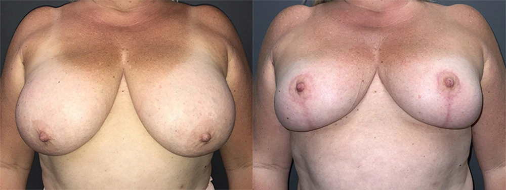 Real Patient Results in Newport Beach, CA. Preformed by Semira Bayait, MD, FACS.