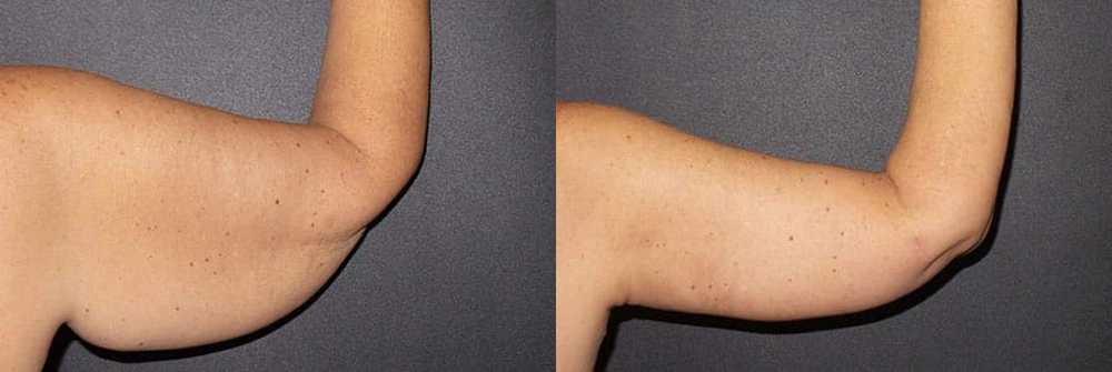 Real Patient Results in Newport Beach, CA. Preformed by Semira Bayait, MD, FACS.
