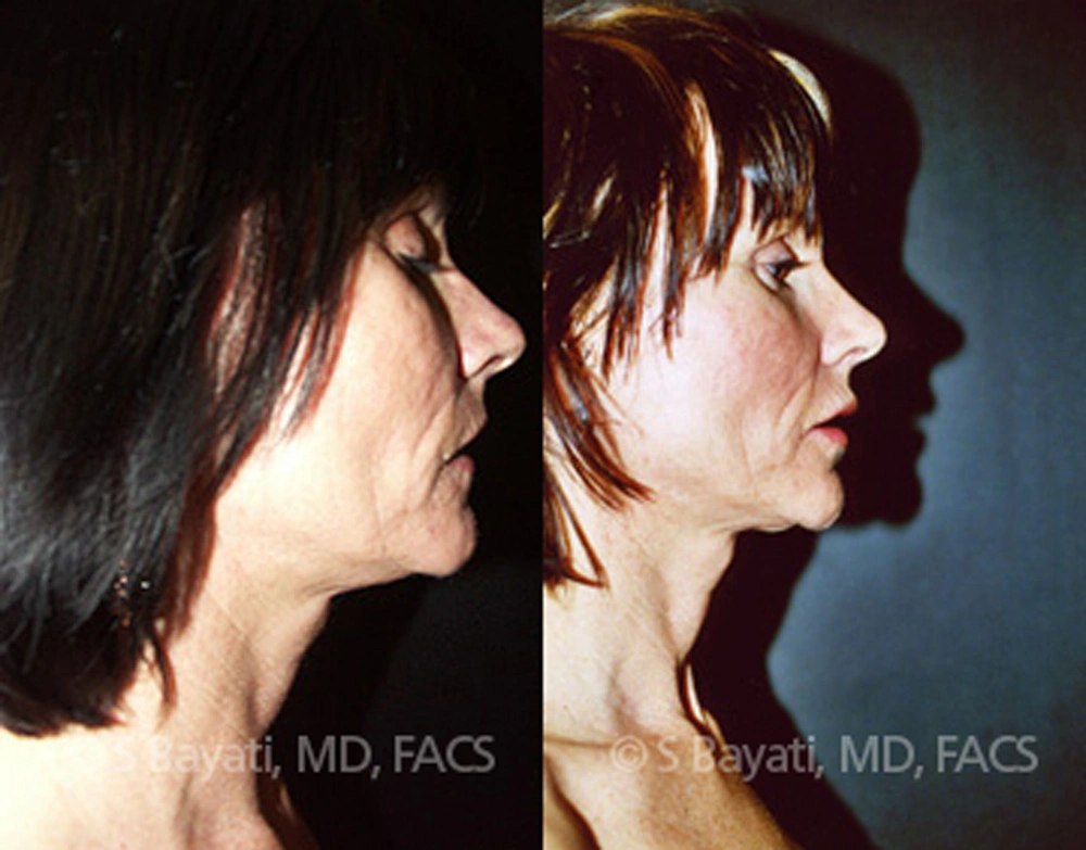 Real Patient Results in Newport Beach, CA. Preformed by Semira Bayait, MD, FACS.