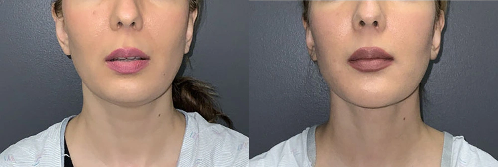 Real Patient Results in Newport Beach, CA. Preformed by Semira Bayait, MD, FACS.