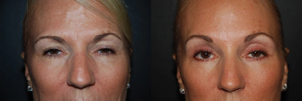 Real Patient Results in Newport Beach, CA. Preformed by Semira Bayait, MD, FACS.