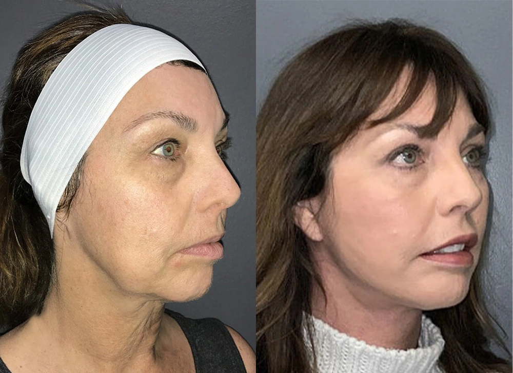 Real Patient Results in Newport Beach, CA. Preformed by Semira Bayait, MD, FACS.