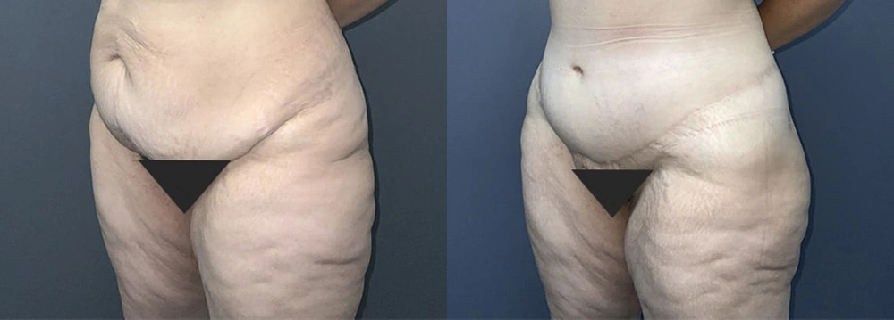 Real Patient Results in Newport Beach, CA. Preformed by Semira Bayait, MD, FACS.