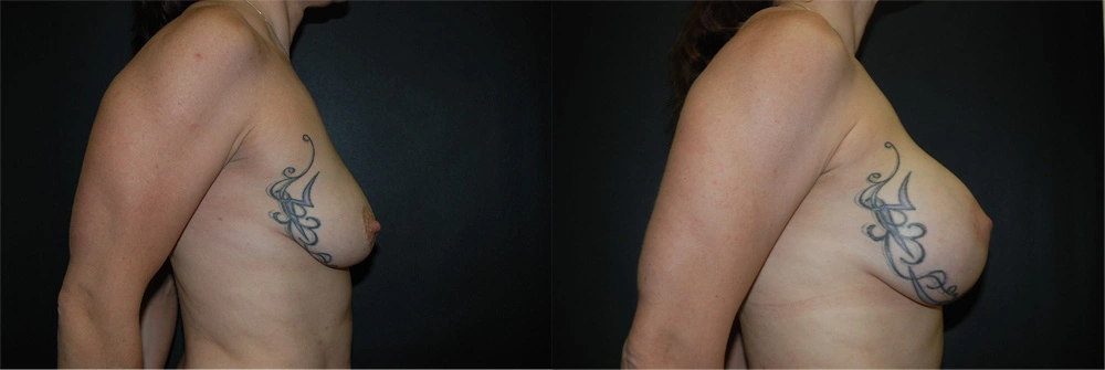 Real Patient Results in Newport Beach, CA. Preformed by Semira Bayait, MD, FACS.