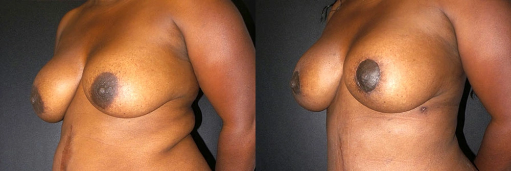 Real Patient Results in Newport Beach, CA. Preformed by Semira Bayait, MD, FACS.