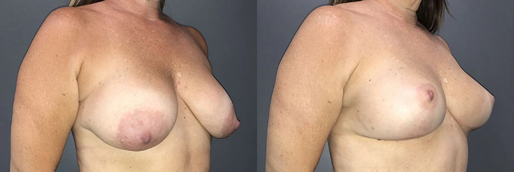 Real Patient Results in Newport Beach, CA. Preformed by Semira Bayait, MD, FACS.