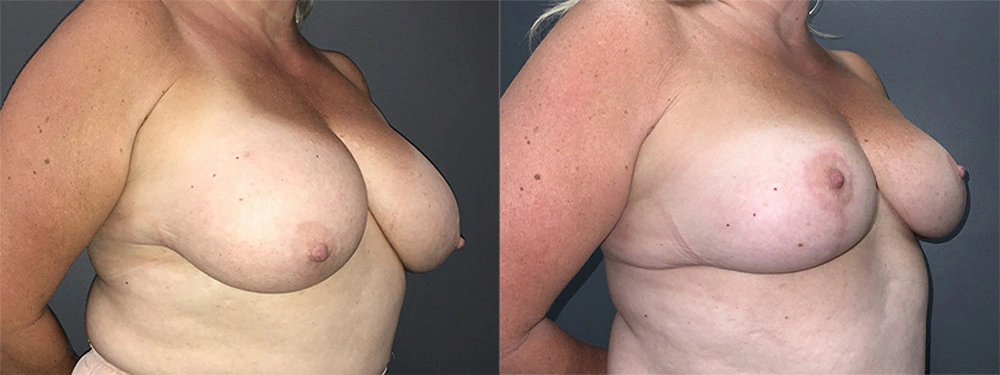 Real Patient Results in Newport Beach, CA. Preformed by Semira Bayait, MD, FACS.