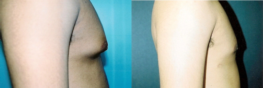 Real Patient Results in Newport Beach, CA. Preformed by Semira Bayait, MD, FACS.