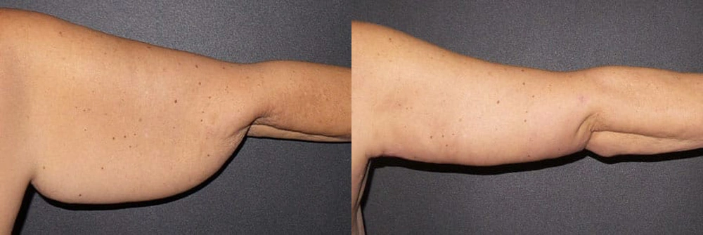 Real Patient Results in Newport Beach, CA. Preformed by Semira Bayait, MD, FACS.