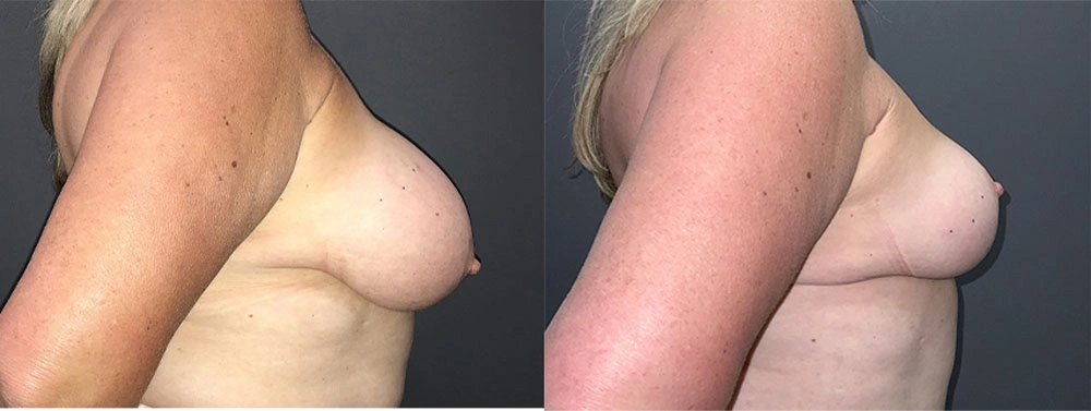 Real Patient Results in Newport Beach, CA. Preformed by Semira Bayait, MD, FACS.
