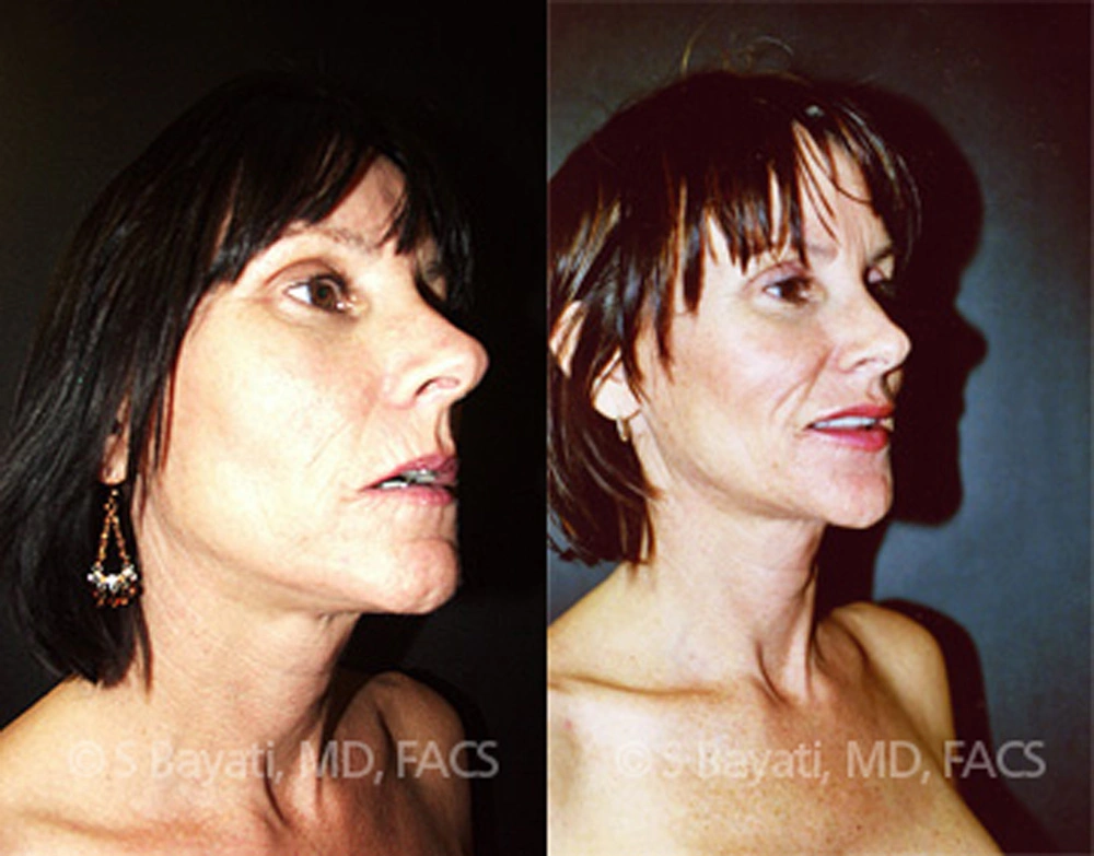 Real Patient Results in Newport Beach, CA. Preformed by Semira Bayait, MD, FACS.