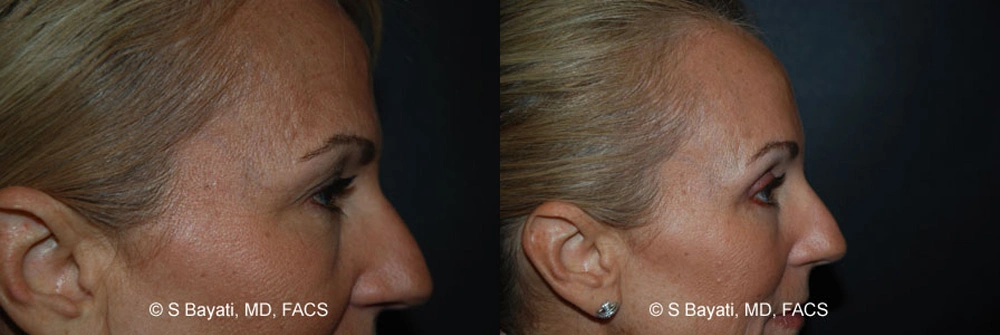 Real Patient Results in Newport Beach, CA. Preformed by Semira Bayait, MD, FACS.