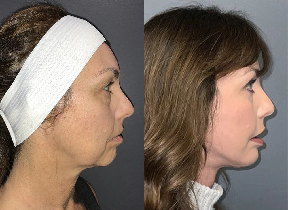 Real Patient Results in Newport Beach, CA. Preformed by Semira Bayait, MD, FACS.