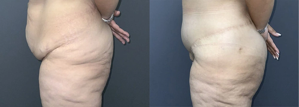 Real Patient Results in Newport Beach, CA. Preformed by Semira Bayait, MD, FACS.