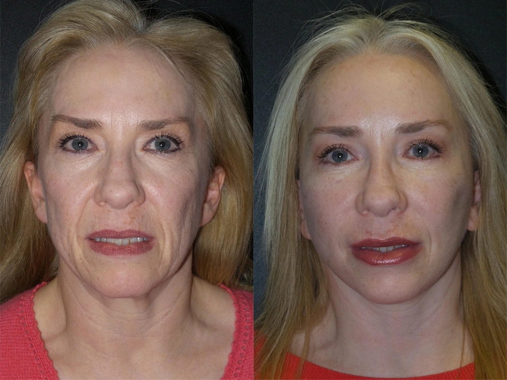 Real Patient Results in Newport Beach, CA. Preformed by Semira Bayait, MD, FACS.