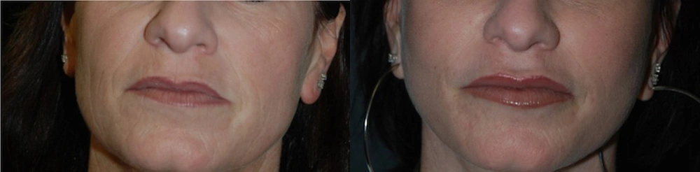 Real Patient Results in Newport Beach, CA. Preformed by Semira Bayait, MD, FACS.