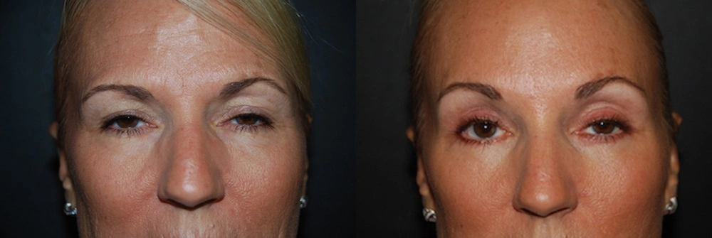 Real Patient Results in Newport Beach, CA. Preformed by Semira Bayait, MD, FACS.