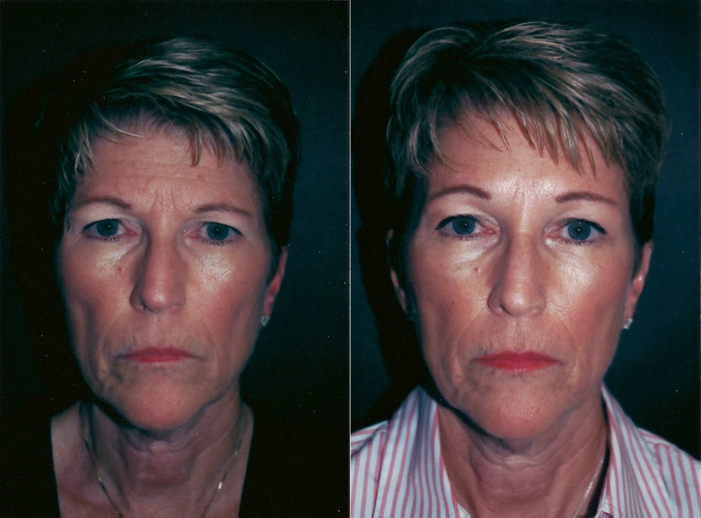 Real Patient Results in Newport Beach, CA. Preformed by Semira Bayait, MD, FACS.