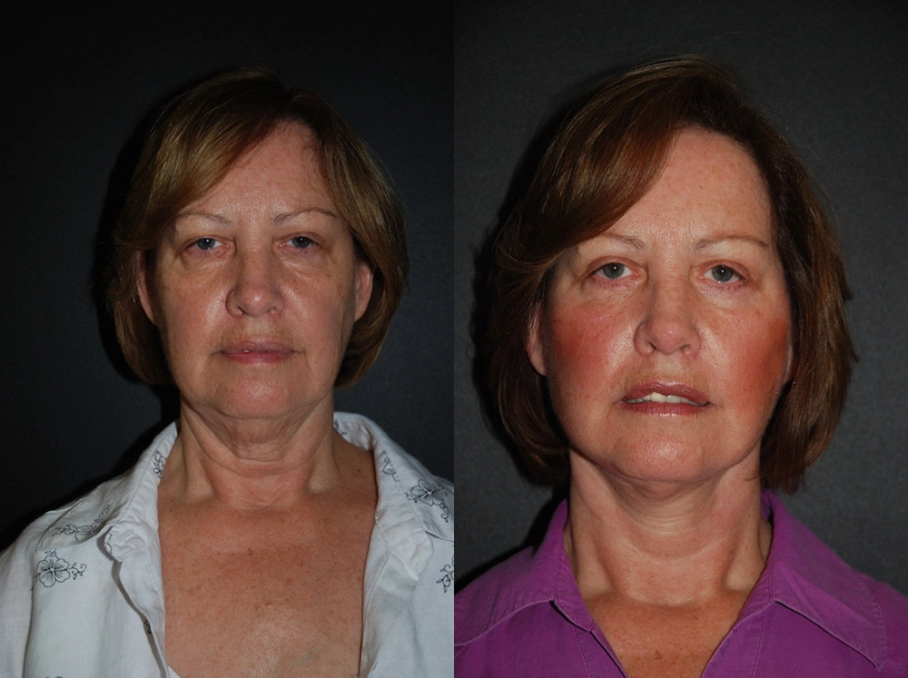 Real Patient Results in Newport Beach, CA. Preformed by Semira Bayait, MD, FACS.
