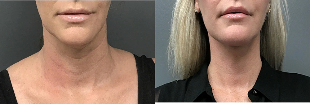 Real Patient Results in Newport Beach, CA. Preformed by Semira Bayait, MD, FACS.